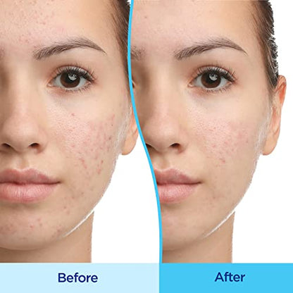 Differin Acne Treatment Gel, 90 Day Supply, Retinoid Treatment For Face DifferinBuy Supplements Australia