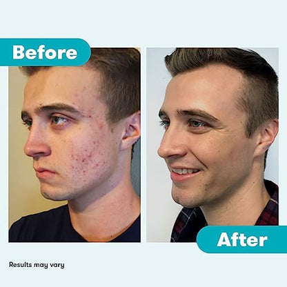 Proactiv 3 Step Acne Treatment - Benzoyl Peroxide Face Wash, Repairing Acne Spot ProactivBuy Supplements Australia