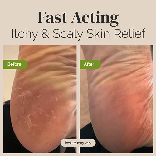 Tea Tree Oil Balm , Extra Strength, Pair Well with Jock Itch Cream, Spray, Athletes Foot PuriyaBuy Supplements Australia