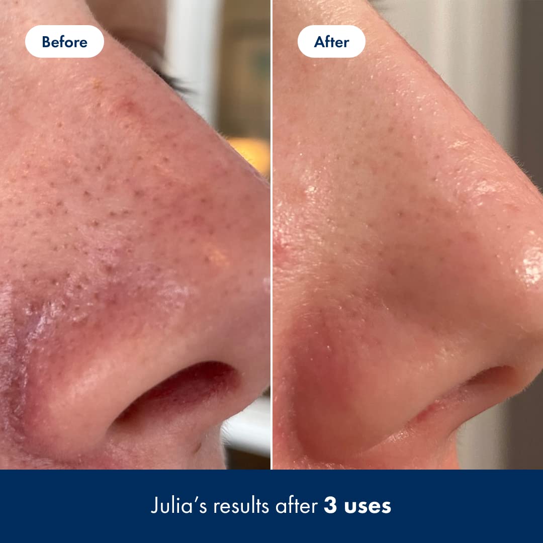 Hero Cosmetics Pore Release Blackhead Clearing Solution - Exfoliating Toner Featuring BHA HERO COSMETICSBuy Supplements Australia