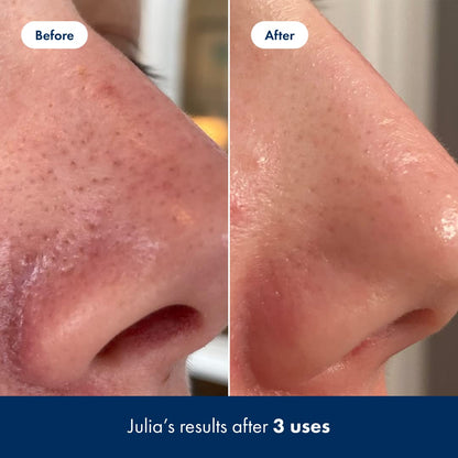 Hero Cosmetics Pore Release Blackhead Clearing Solution - Exfoliating Toner Featuring BHA HERO COSMETICSBuy Supplements Australia