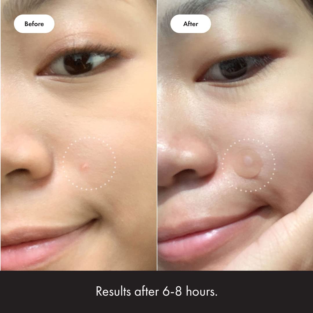 Mighty Patch Original from Hero Cosmetics - Hydrocolloid Acne Pimple Mighty PatchBuy Supplements Australia