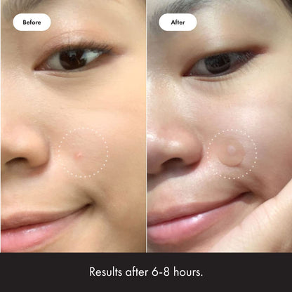 Mighty Patch Original from Hero Cosmetics - Hydrocolloid Acne Pimple Mighty PatchBuy Supplements Australia