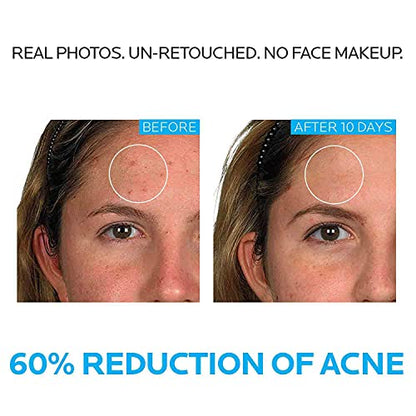 La Roche-Posay Effaclar Dermatological 3 Step Acne Treatment System La Roche-PosayBuy Supplements Australia