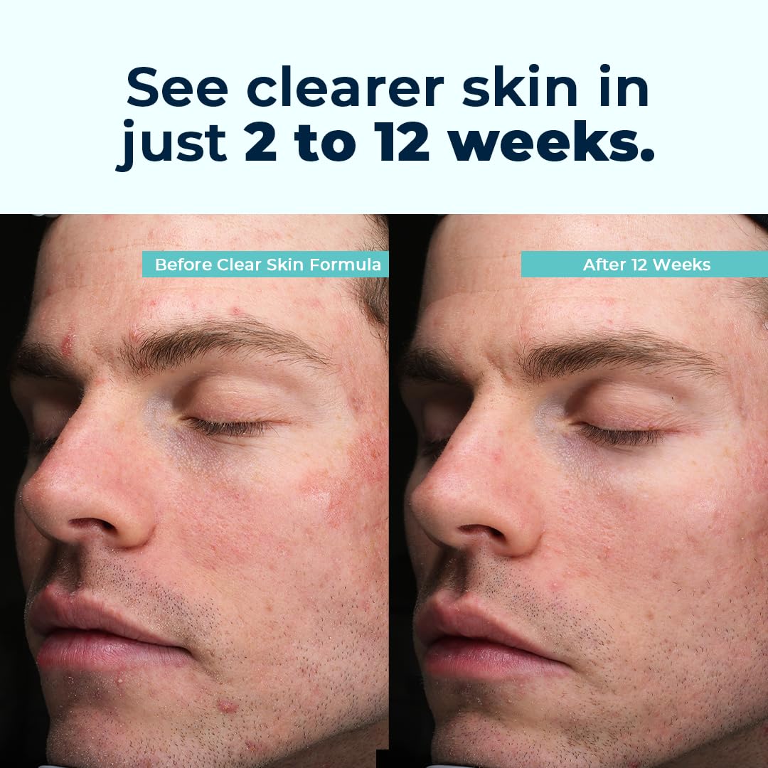 VitaMedica Clear Skin Vitamin Formula | Noncystic Acne Supplement for Skin Clearing | Breakout Treatment for Women and Men | Vitamins A, C, E, Selenium, Chromium, and Zinc for Skin Health | 2 Pack VitaMedicaBuy Supplements Australia