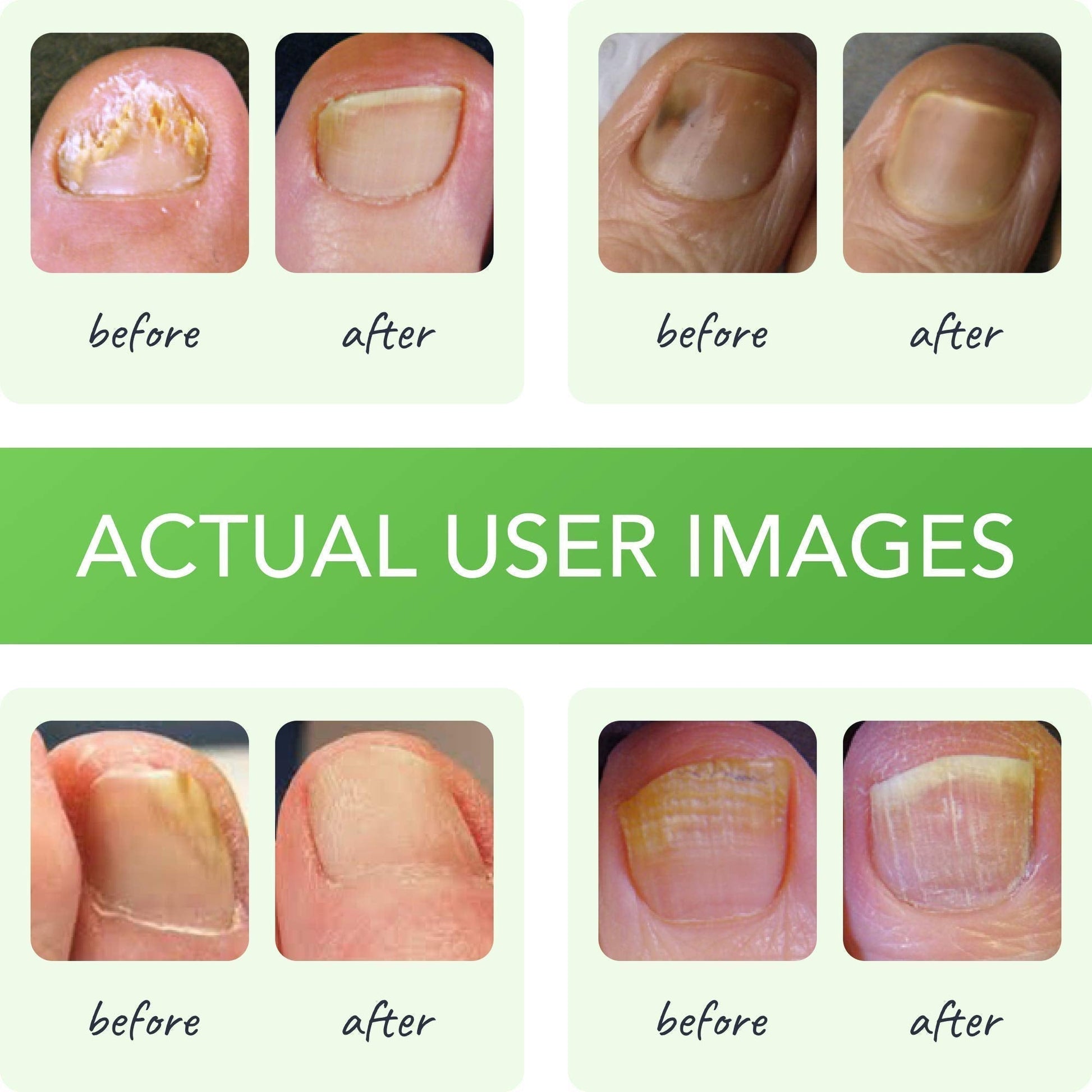 FUNGINIX Healthy Nail Formula - Finger And Toe Fungus Treatment, Made In USA, Foot FUNGINIXBuy Supplements Australia
