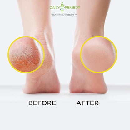 Citrus Detox Foot Soak with Epsom Salt - for Foot Callus, Immune Boost, Damaged Toenail DAILY REMEDYBuy Supplements Australia