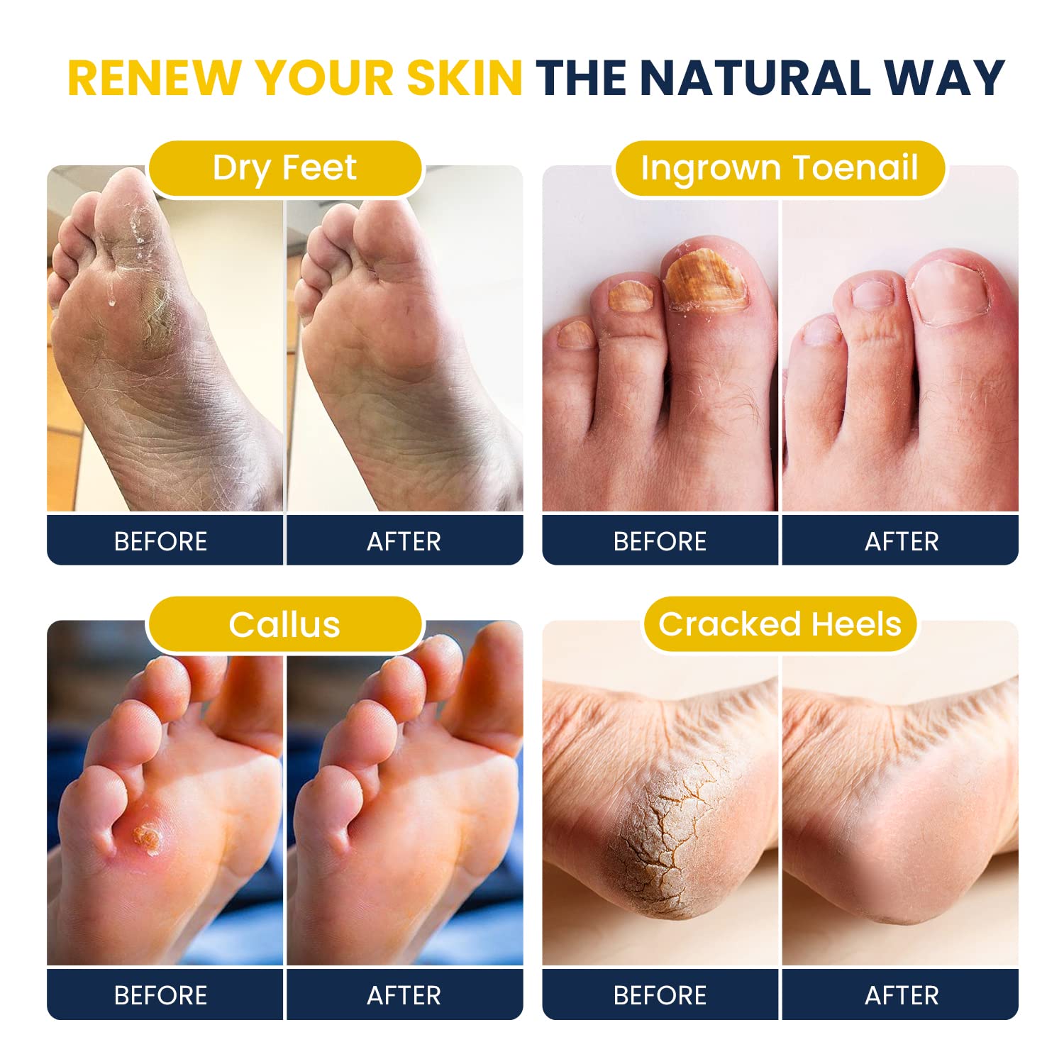 Citrus Detox Foot Soak With Epsom Salts - for Foot Callus, Immune Boost, Damaged Toenail FOOT CUREBuy Supplements Australia