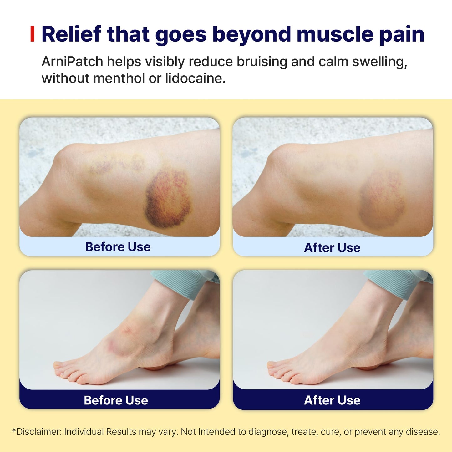 Arnica Hydrogel Pain Relief Patches | Natural Relief for Muscle, Joint, Bruises & Swelling | Flexible, Non-Greasy & Long-Lasting | Great for Back, Knee & Neck Pain (3.9"x4.7", 10, Count) Wooshin LabottachBuy Supplements Australia