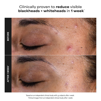 Paulas Choice--SKIN PERFECTING 2% BHA Liquid Salicylic Acid Exfoliant--Facial Exfoliant