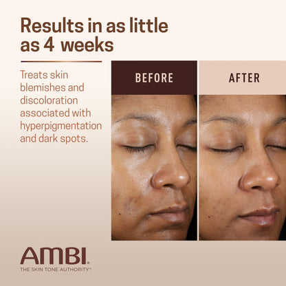Ambi Even & Clear Advanced Fade Cream, Hydroquinone-free, Hyperpigmentation Treatment, Stubborn Dark Spot Corrector, Results In As Little As 2-3 Weeks - Maple Wellness Supplements