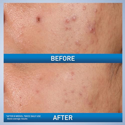 CeraVe Acne Control Gel, 2% Salicylic Acid Treatment With Glycolic Acid + Lactic Acids - Maple Wellness Supplements