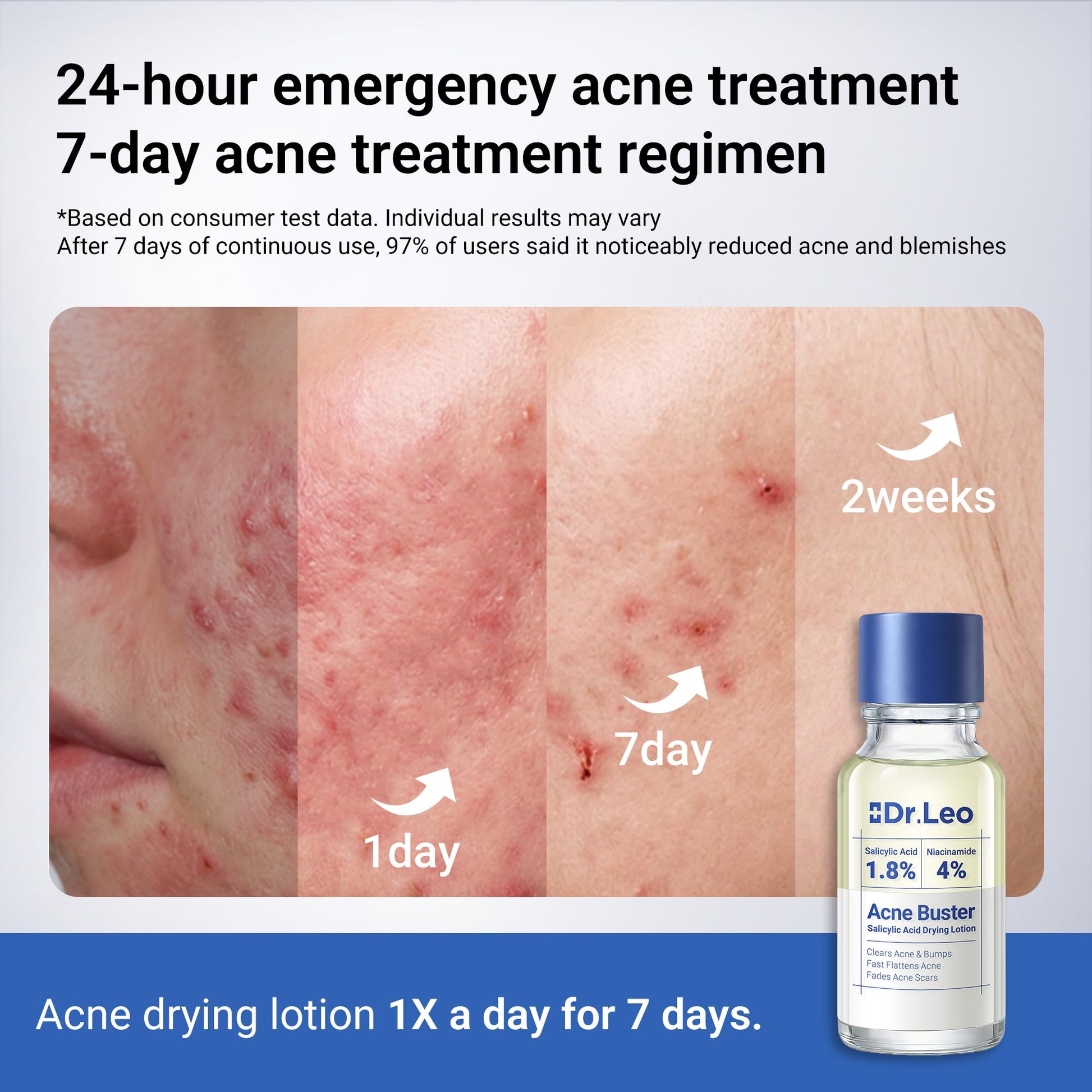 Dr.Leo 1.8% Salicylic Acid Spot Serum, Acne Treatment for Acne-Prone Sensitive Skin | Niacinamide, Fast Pimple Relief, Fades Acne Marks - Maple Wellness Supplements