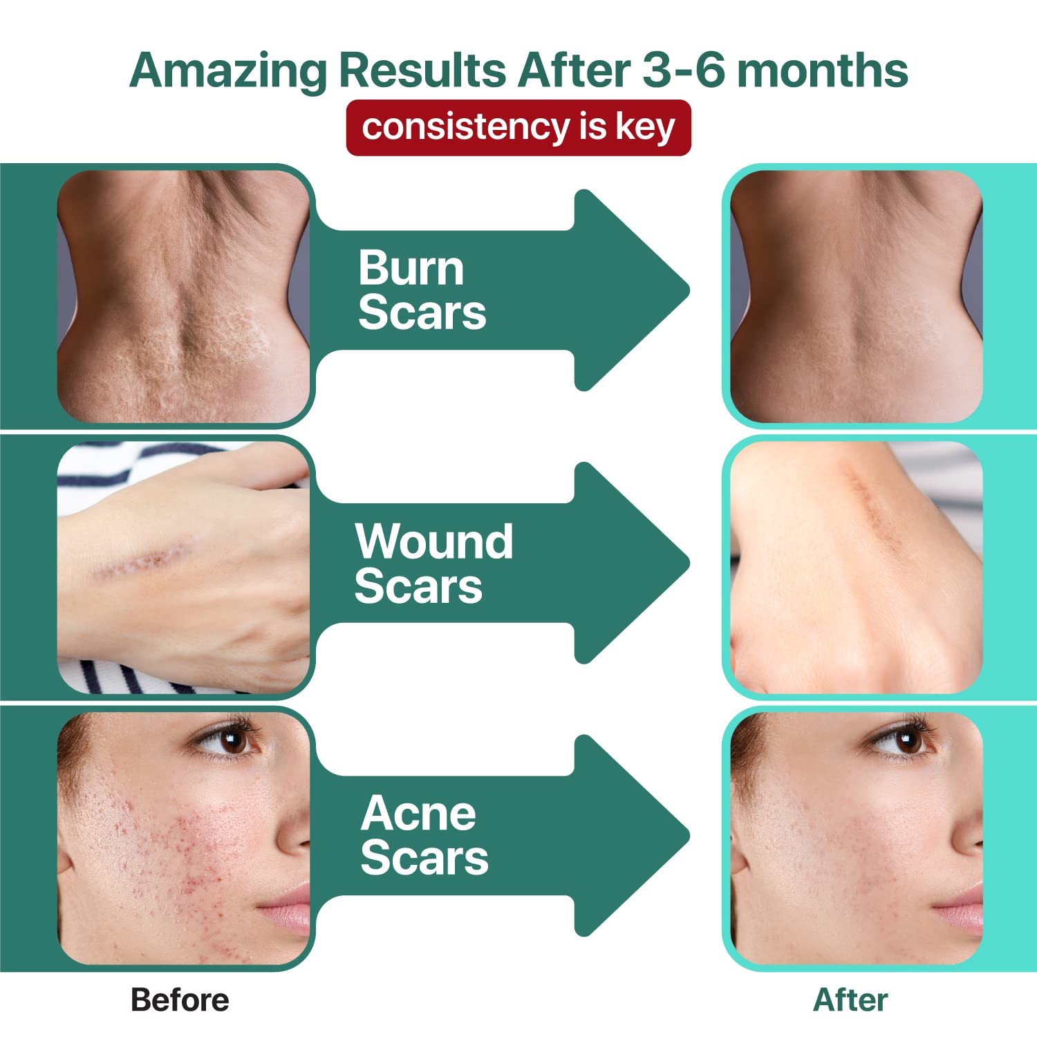 Ebanel Bundle of Lidocaine Numbing Cream, and Advanced Silicone Scar Gel 1 Oz - Maple Wellness Supplements