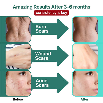 Ebanel Bundle of Lidocaine Numbing Cream, and Advanced Silicone Scar Gel 1 Oz - Maple Wellness Supplements