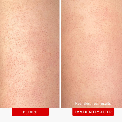 First Aid Beauty - KP Bump Eraser Body Scrub with 10% AHA, Keratosis Pilaris Exfoliator with Glycolic and Lactic acids, Helps Reduce Chicken Skin Bumps - Maple Wellness Supplements