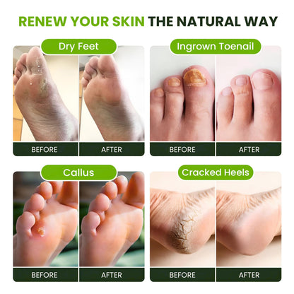 FOOT CURE Tea Tree Oil Foot Soak with Epsom Salt - Best Toenail Fungus Treatment, Athletes Foot & Softens Calluses - Soothes Sore & Tired Feet, Fungal Toe, Foot Odor Scent, Spa Pedicure (Pack of 2) - Maple Wellness Supplements