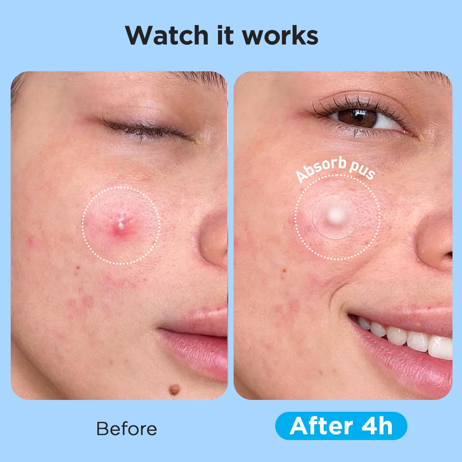 Glowpatch Pimple Patches for Face (504 Count), FSA Eligible Acne Patch Bulk, Zit Stickers 4 Sizes, Hydrocolloid Spot Stickers - Maple Wellness Supplements