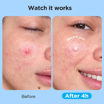 Glowpatch Pimple Patches for Face (504 Count), FSA Eligible Acne Patch Bulk, Zit Stickers 4 Sizes, Hydrocolloid Spot Stickers - Maple Wellness Supplements