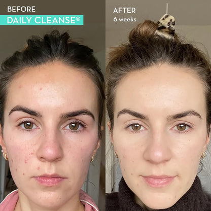 HUM Daily Cleanse Acne Supplements - Support for Clear Skin & Improved Digestion - Maple Wellness Supplements