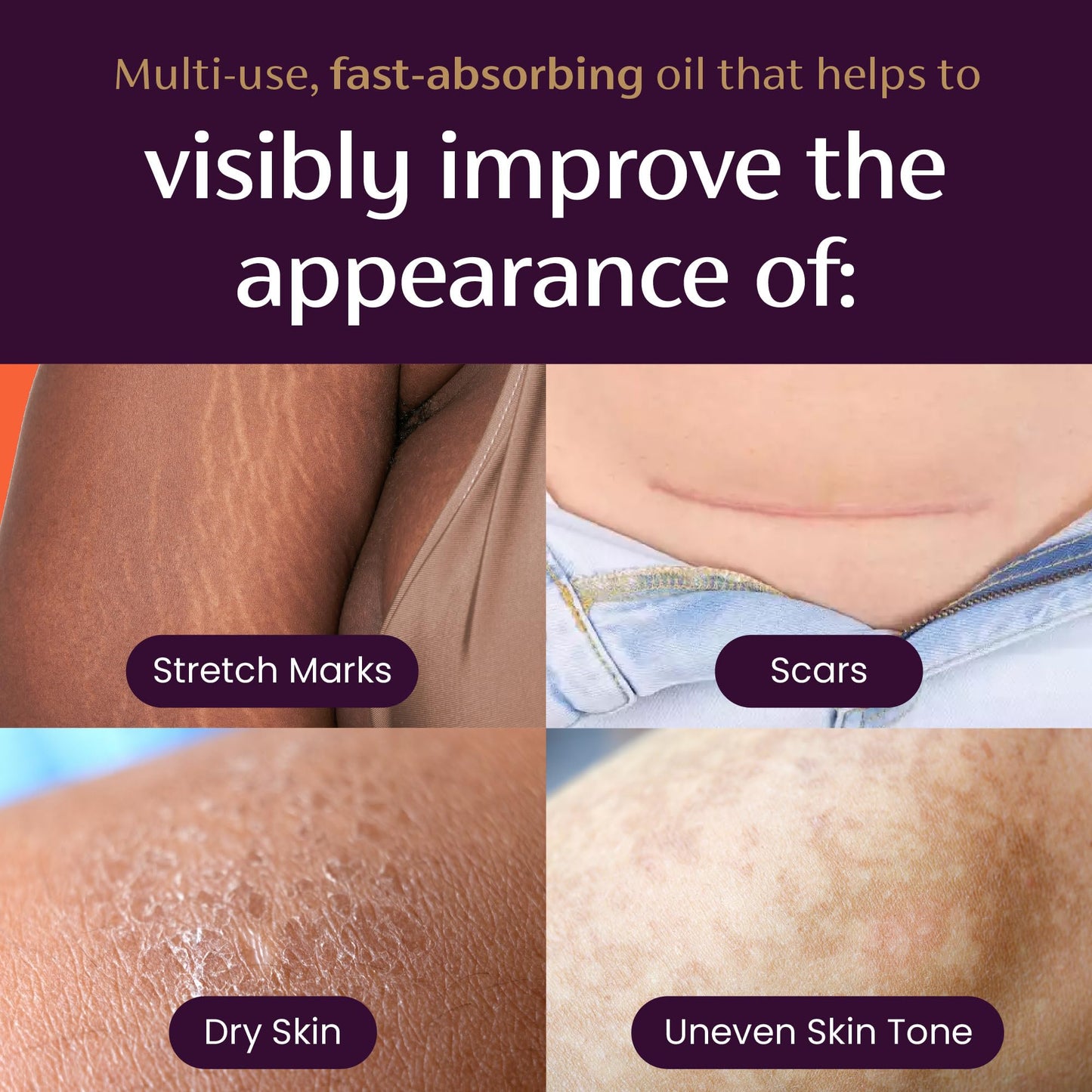 Mederma Quick Dry Oil, Scar and Stretch Mark Treatment, Helps to Improve the Appearance with Natural Botanical Extracts, Paraben Free, Fast-Absorbing, 3.4oz (100ml) - Maple Wellness Supplements