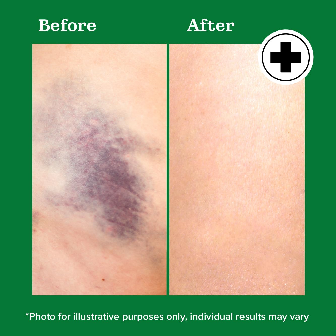 Miracle Plus Arnica Bruise Relief Gel + Magnesium Leg Relief Cream Bundle - Maple Wellness Supplements