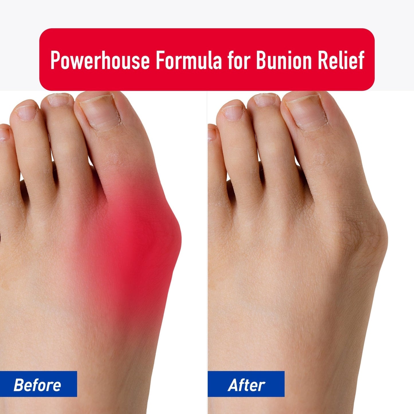 PROFOOT Bunion Relief Rub, White - Maple Wellness Supplements