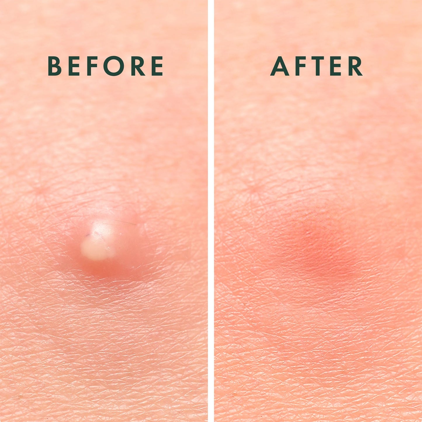 Rael Pimple Patches, Miracle Invisible Spot Cover - Hydrocolloid Acne Pimple Patch - Maple Wellness Supplements