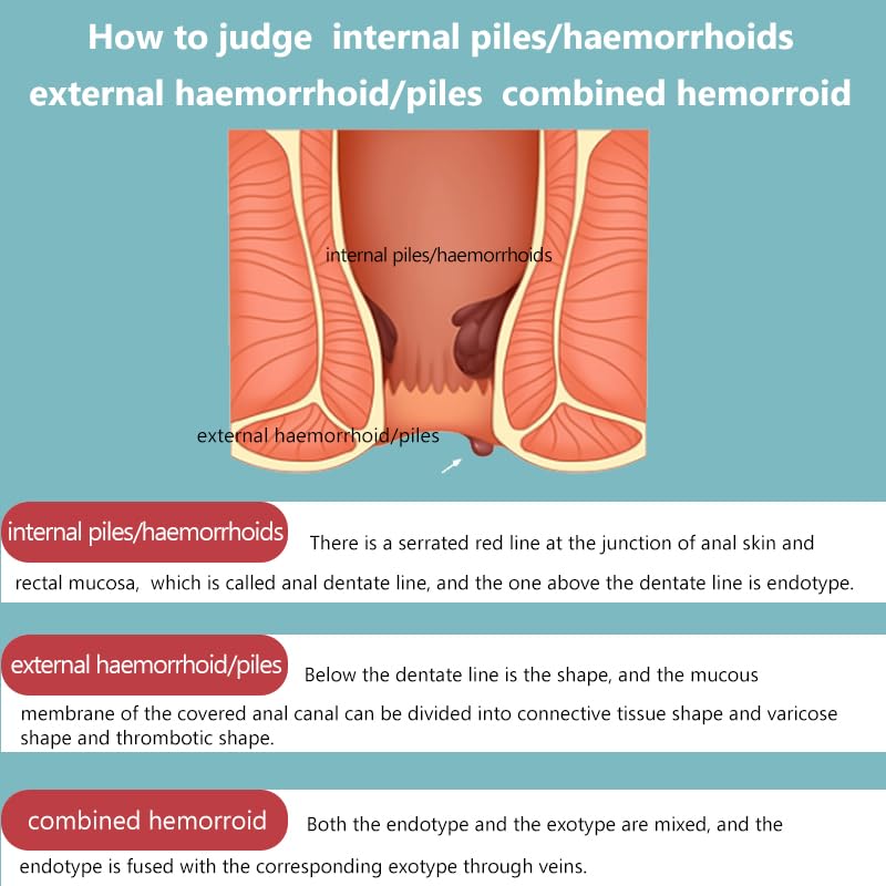 SERYNTH Hemorrhoid and Anal Fissure Ointment, Hemorrhoid Treatment, Fast Relief from Swelling, Pain, Itching, Burning (20g) - Maple Wellness Supplements