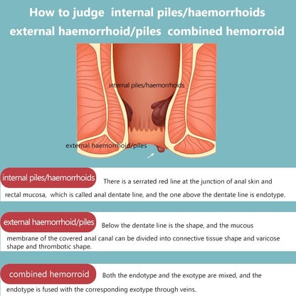 SERYNTH Hemorrhoid and Anal Fissure Ointment, Hemorrhoid Treatment, Fast Relief from Swelling, Pain, Itching, Burning (20g) - Maple Wellness Supplements