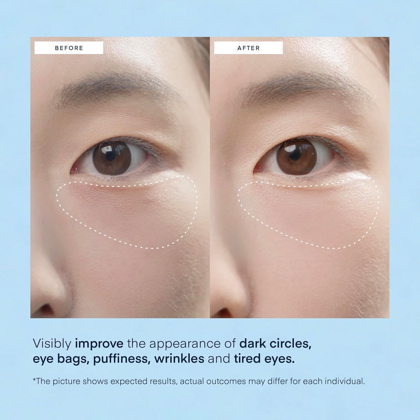 Terez & Honor Under Eye Patches for Dark Circles - 60 Korean Hydrogel Masks for Puffiness - Maple Wellness Supplements