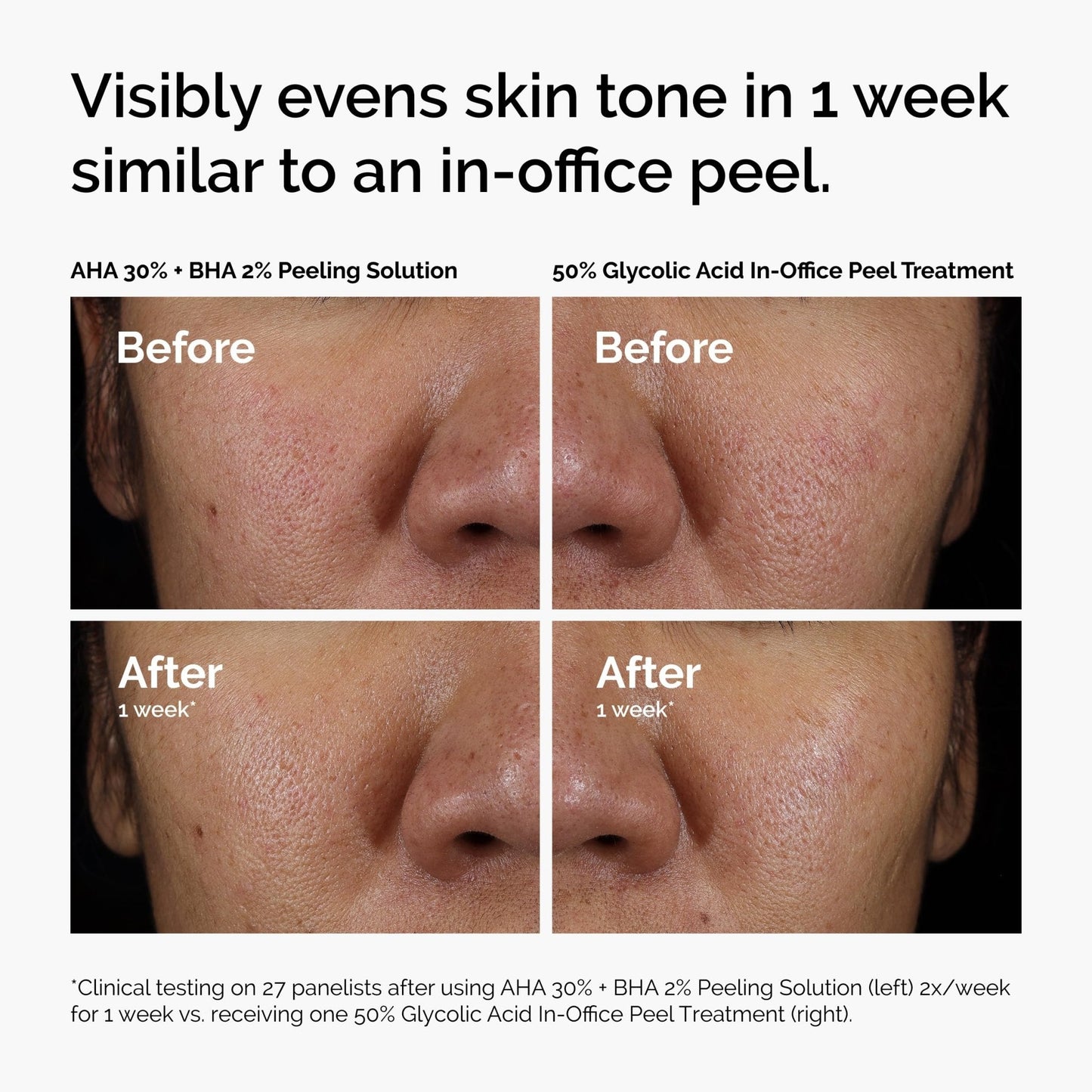 The Ordinary AHA 30% + BHA 2% Peeling Solution, Advanced Exfoliating Peel for Brighter Skin, 1 Fl Oz - Maple Wellness Supplements